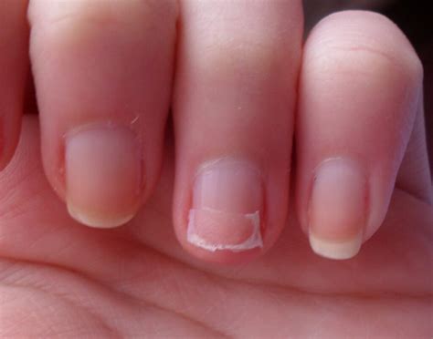Bdo moons split nail - Solutions There are several ways to prevent and minimize the occurrence of side splits in nails. Consider following these tips: Keep your nails trimmed: Maintain your nails at a …